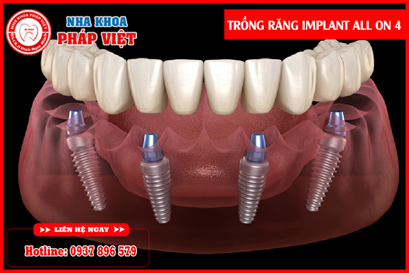 Trồng răng implant all on 4