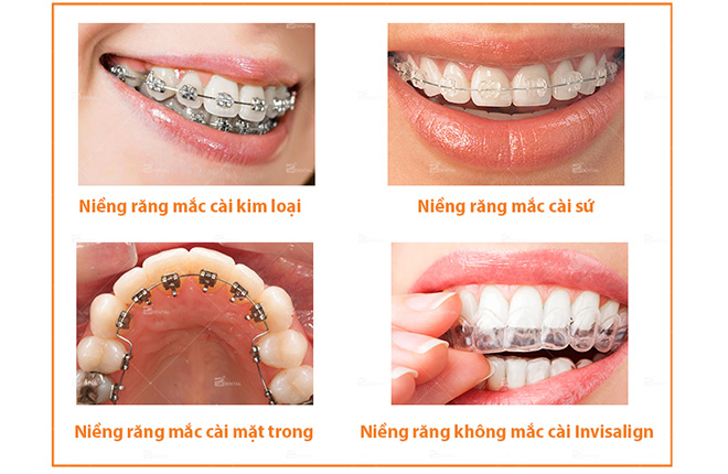 Phương pháp niềng răng