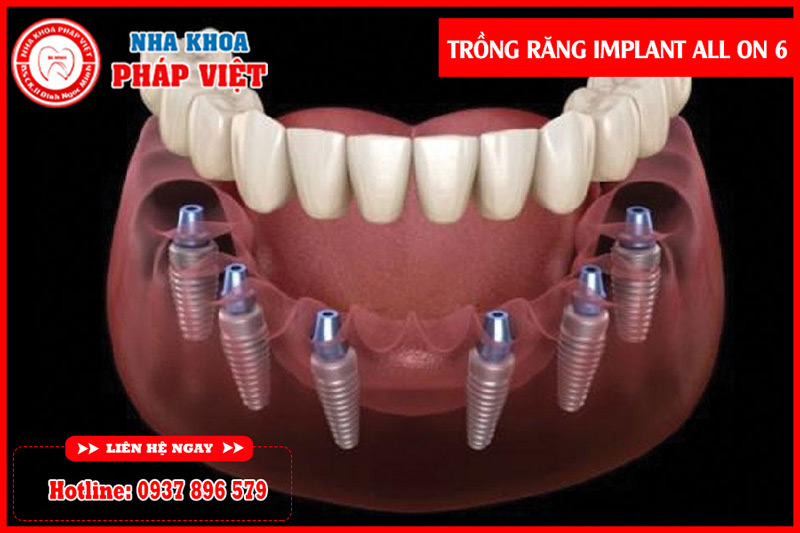 Trồng răng implant all on h6